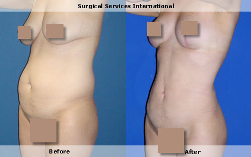 Liposuction, stomach